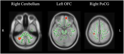 Altered White Matter Integrity in Smokers Is Associated with Smoking Cessation Outcomes
